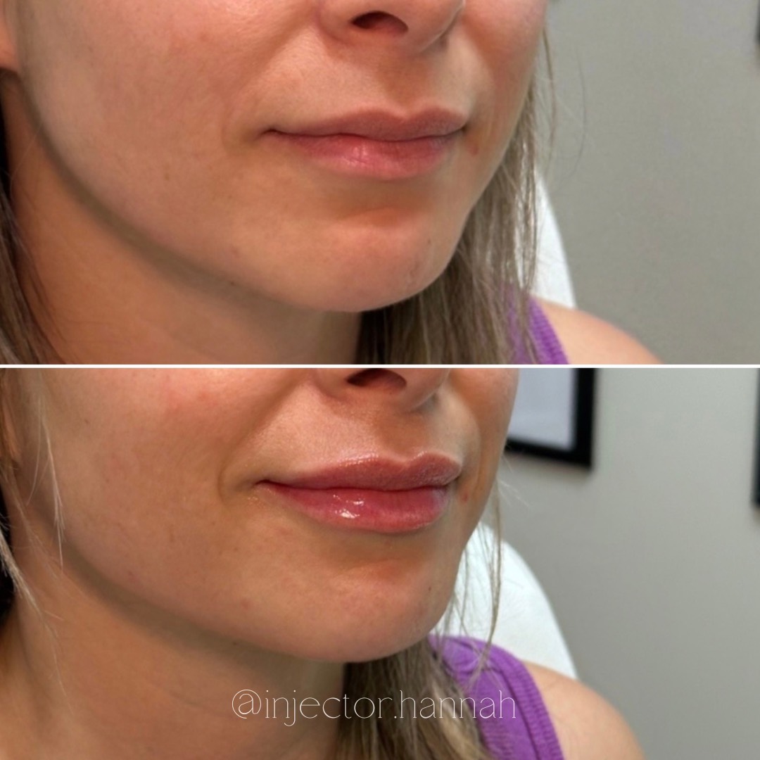 Forehead lines before/after – smoother after 2 weeks